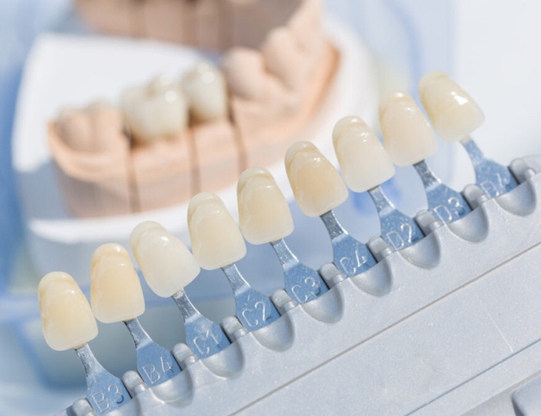 摂津市（千里丘）の歯医者、ひろ歯科の審美歯科