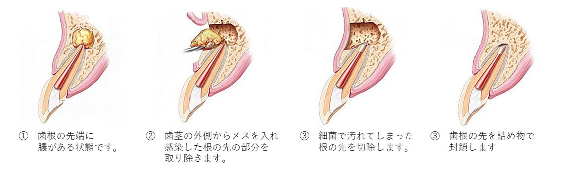 摂津市（千里丘）の歯医者、ひろ歯科の根管治療