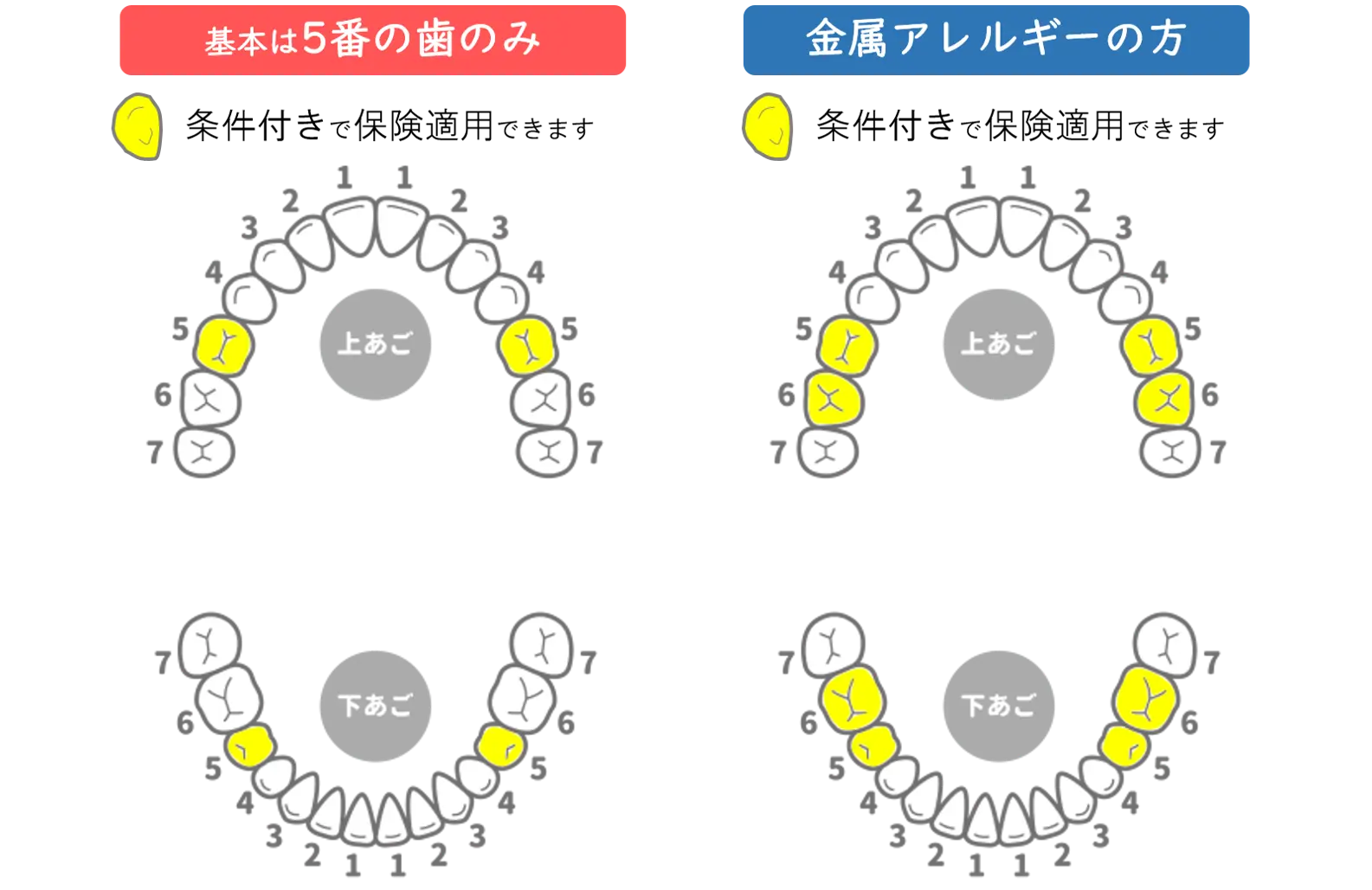 岡崎市の歯医者、ヒロデンタルオフィスの保険適用の白い歯