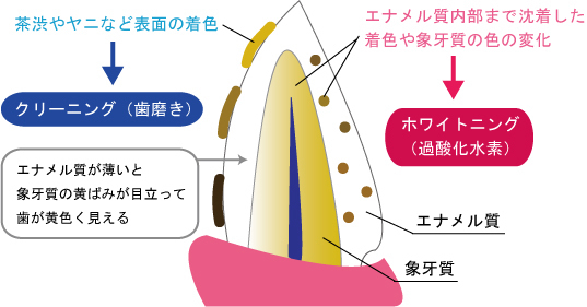 摂津市（千里丘）の歯医者、ひろ歯科のホワイトニング